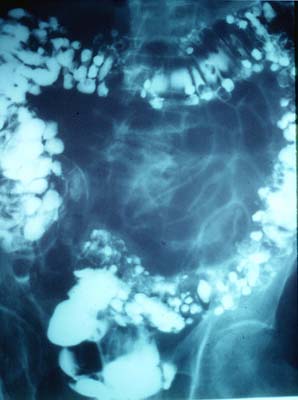 colon diverticulosis X-Ray Image 